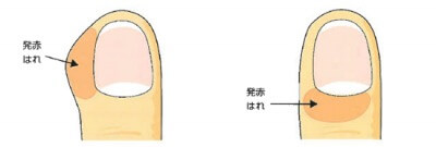 爪周囲炎